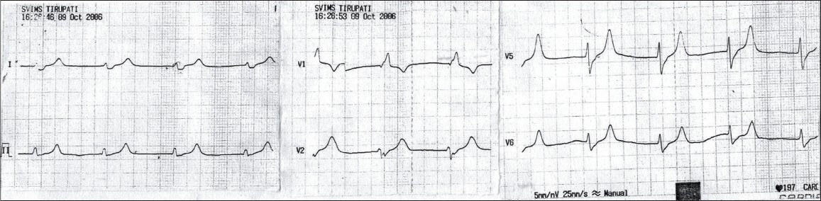 Showing features suggestive of hyperkalemia (S.K 7 meq/I): Rate 63/min, absent P waves, junctional rhythm, with tall T waves