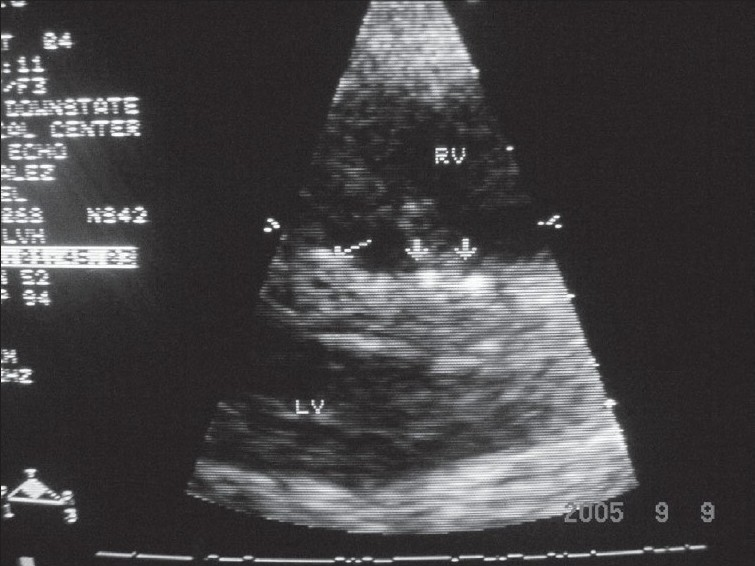 Parasternal long-axis view showing discrete small areas of calcification in interventricular septum