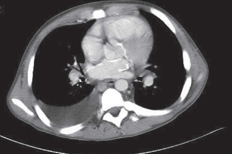 Chest CT scan showing cardiac calcification involving left atrium aortic root, proximal coronaries and mitral valve ring