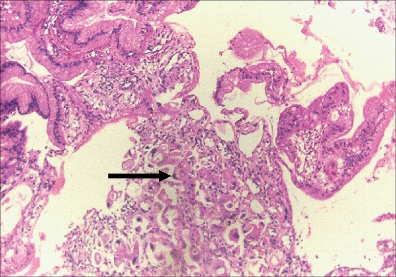 Gastric biopsy showing moderately differentiated adenocarcinom (H&E, ×150)
