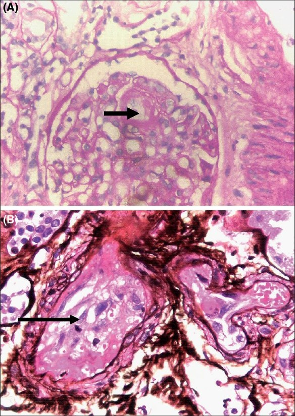 (A) Kidney biopsy showing fibrin thrombi (arrow) in the capillary lumen (periodic acid-Schiff (PAS) stain, ×400). (B) Kidney biopsy showing fibrin thrombi (arrow) in a medium sized vessel. (silver methenamine stain, ×400)