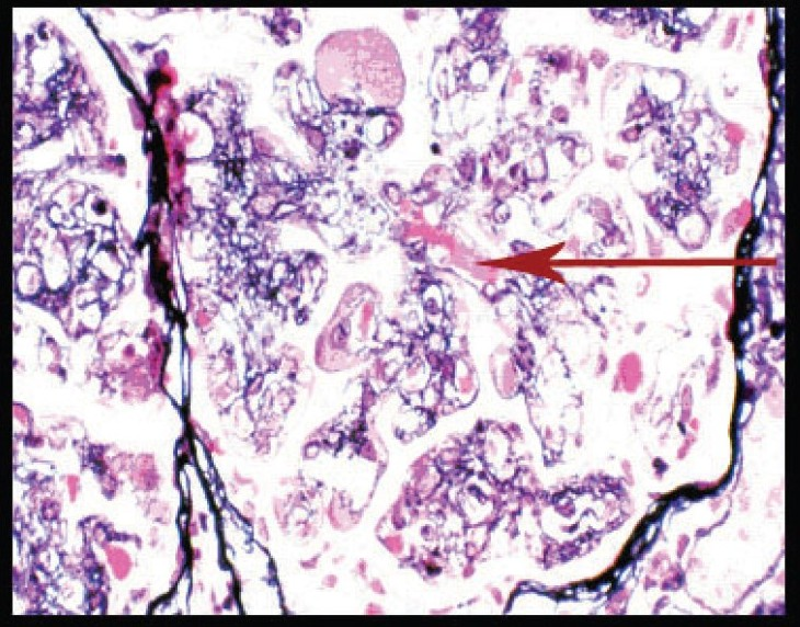 Silver methenamine stain showing basement membrane splitting, interposition of mesangium, and intracapillary hyaline like deposits (arrow) (magnification ×400)