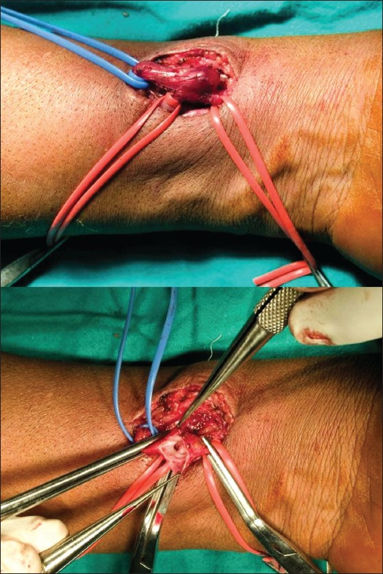 Left end-to-side arteriovenous fistula with exposed vascular anatomy prior to ligation