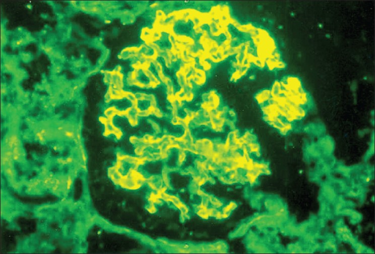 Immunofluorescence staining showing glomeruli with linear positivity for IgG (×400)
