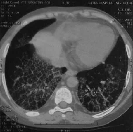 Sirolimus-induced pneumonitis