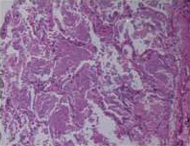 Lung biopsy showing parenchymal lung lesion. Transbronchial lung biopsy shows normal bronchial epithelium, bronchial cartilage, and surrounding lung tissue. Alveoli contain a granular proteinaceous material (arrows). This material is also seen lying loosely in the extraalvelor area. No fungus, acid-fast bacillus, or pneumocystis carinii are seen.