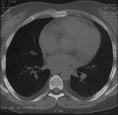Resolved Sirolimus-induced pneumonitis