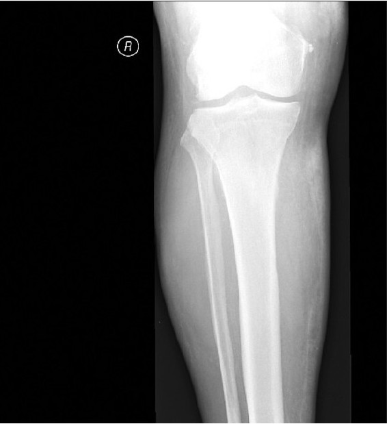 Soft tissue x-ray showed increased density on medial aspect of right lower leg