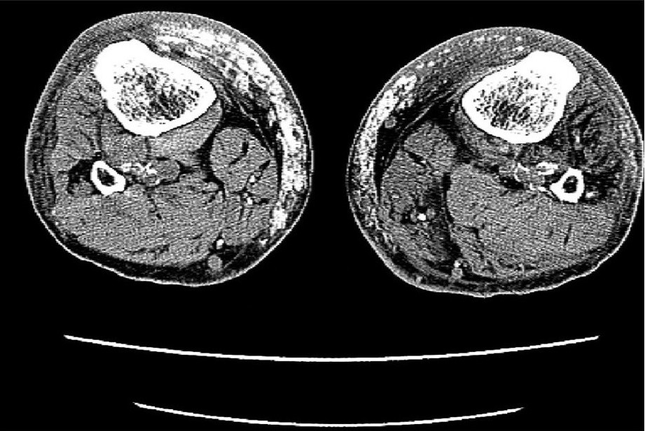 CT images of lower extremities showed calcified vessels and subcutaneous calcification