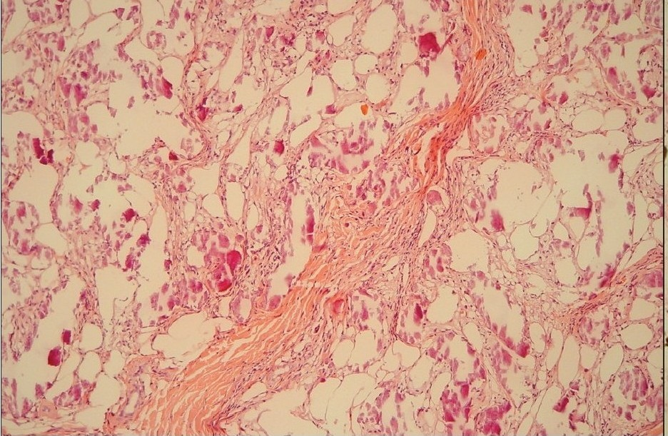 H and E stain of skin lesions showed lobular dystrophic calcified panniculitis and adipose tissue necrosis