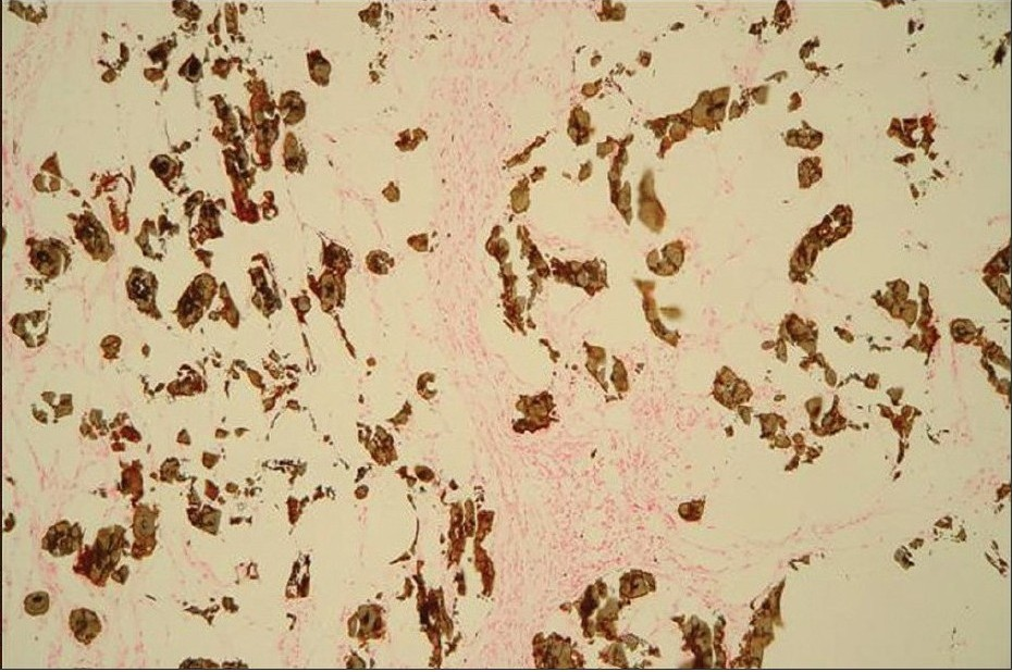 A von Kossa stain of the same case demonstrates calcium deposits in subcutaneous fat and in the walls of vessels