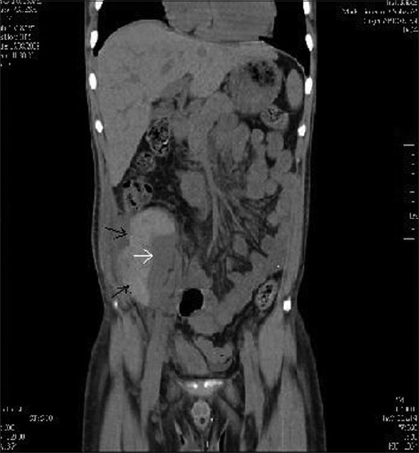 CT of the abdomen-(coronal section) showing sub capsular hematoma (black arrows) compressing the graft kidney (white arrow)