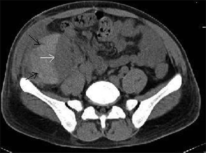 CT of the abdomen (transverse section) showing sub capsular hematoma (black arrows) compressing the graft kidney (white arrow)