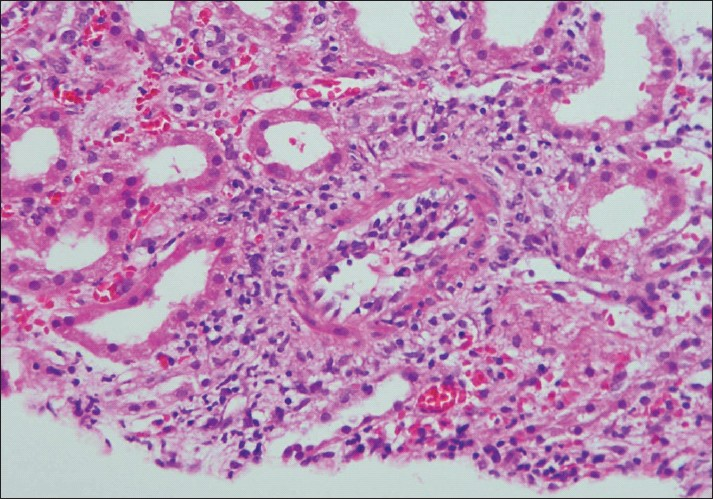 Photomicrograph of a small artery showing subintimal accumulation of mononuclear cells with about 50% narrowing of the luminal vascular area (Intimal arteritis v2) (H and E stain×100)