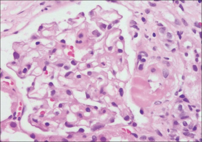 Photomicrograph showing a glomerulus with its afferent arteriole demonstrating a transmural hyaline nodule suggestive of CNI toxicity (H and E stain×200)