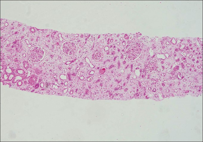 Low-power photomicrograph showing extensive tubular atrophy and interstitial fibrosis (IFTA Grade III) (H and E stain×40)