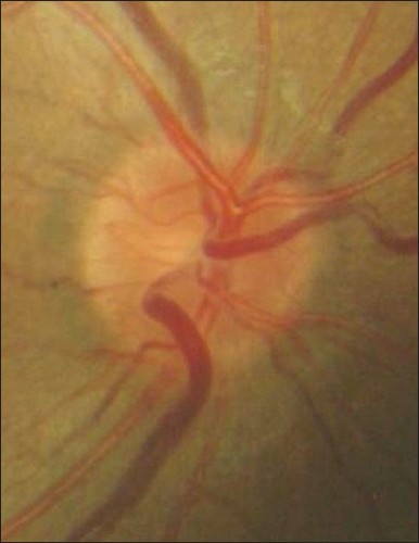 Normal right optic nerve at presentation