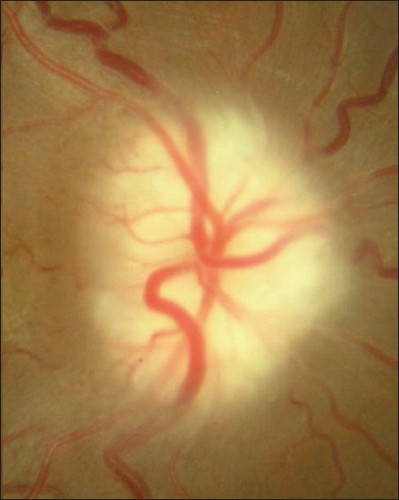 Two weeks later, right optic nerve showing very pale swelling