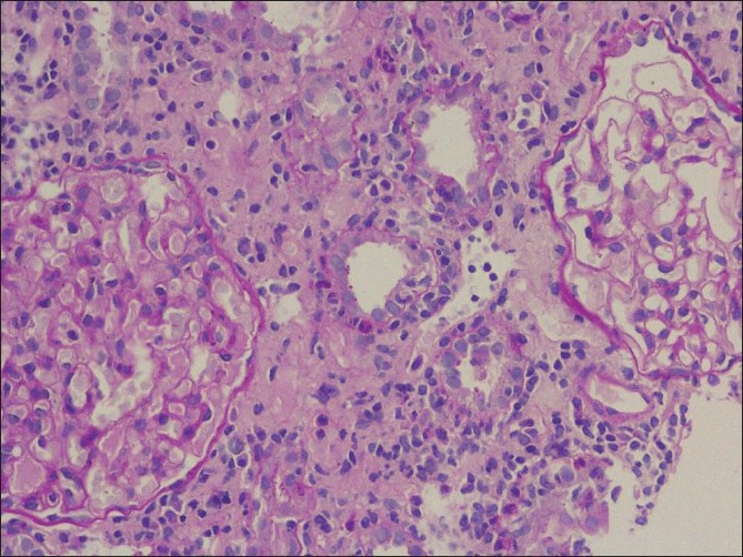 A focus of moderate tubulitis (arrow) along with moderate interstitial edema and inflammation is seen. In addition, the two glomeruli seen in the picture are within normal limits (PAS, ×200)