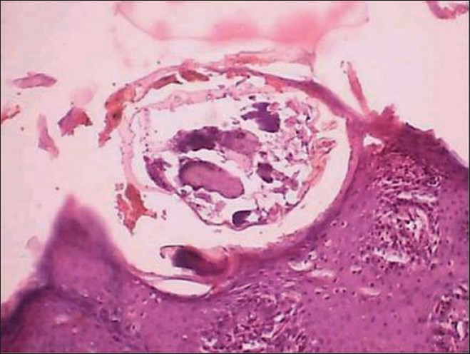 A skin burrow with a larval form of Sarcoptes scabiei