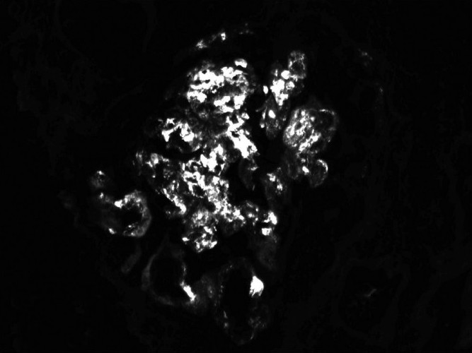 Direct immunofluorescence showing IgA: Coarsely granular mesangial and capillary (3+)