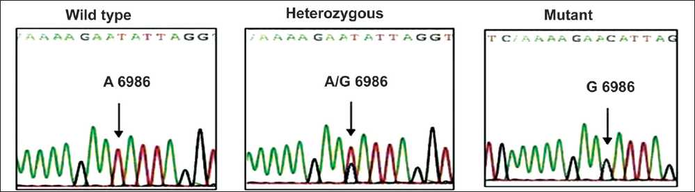 Sequencing results of CYP3A5 A6986G polymorphism