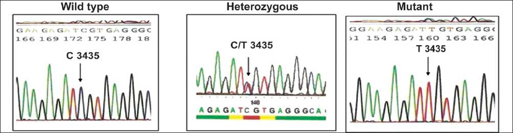 Sequencing results of MDR-1 C3435T polymorphism