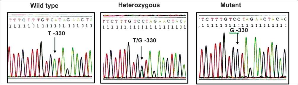 Sequencing results of IL-2 T-330G polymorphism