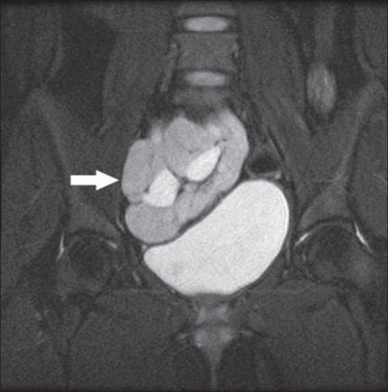 MRI showing pelvic kidney in relation to bladder