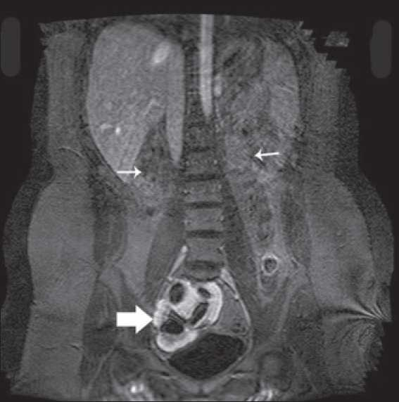 MRI showing empty renal fossae (thin arrow) and pelvic kidney in relation to bladder (thick arrow)