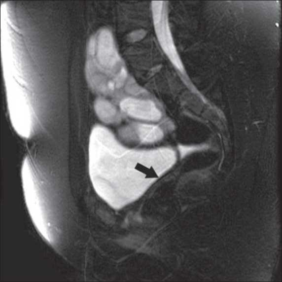 MRI showing pelvic kidney and absent uterus (Arrow)