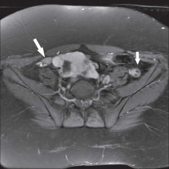 MRI showing bilateral ovaries