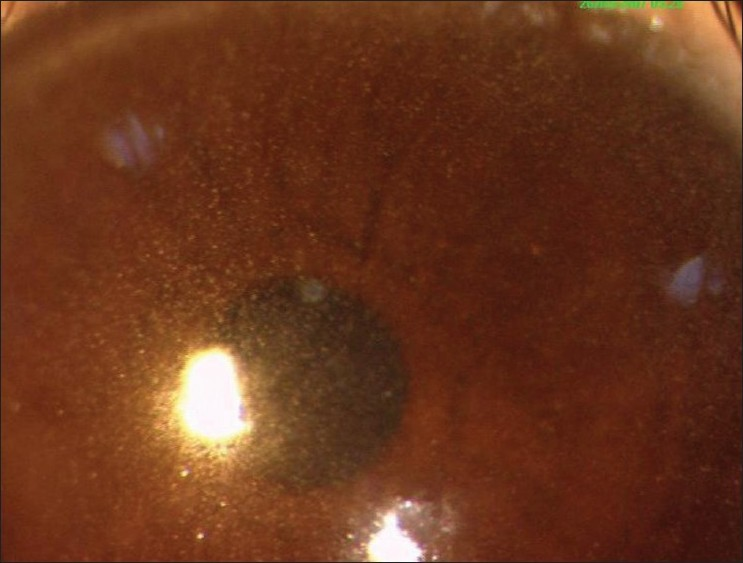 Slit-lamp examination showing fine cystine crystals in the cornea