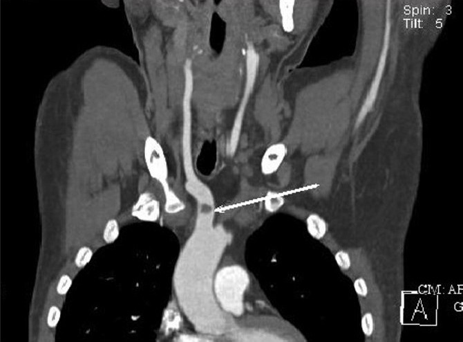 Contrast-enhanced MDCT of neck and thorax, showing partial occlusion of right brachiocephalic trunk (arrow) with thrombus (coronal section)