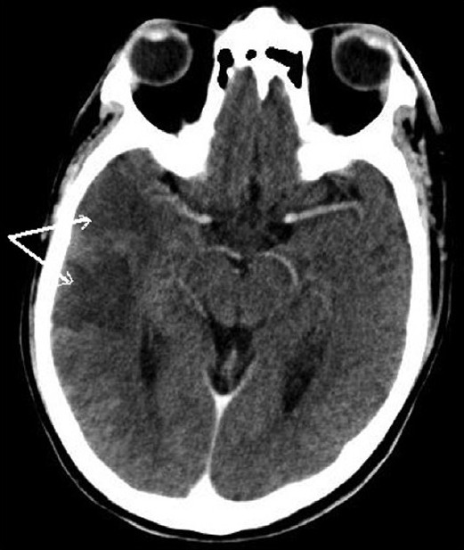 CT scan head shows right MCA territory infarction (arrows)