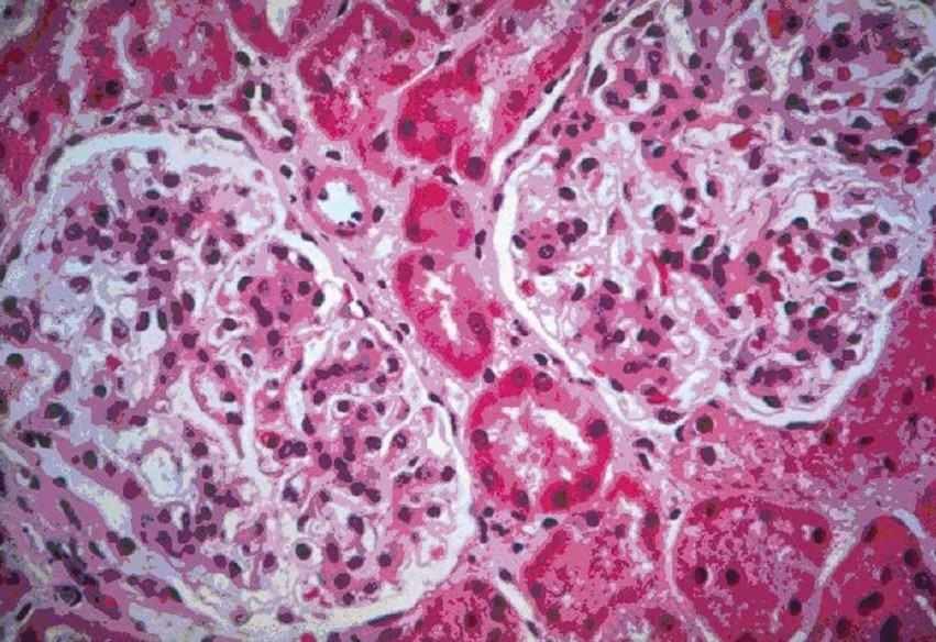 Light microscopy H and E sections show two patent glomeruli with a diffuse increase in the mesagial matrix (100×)