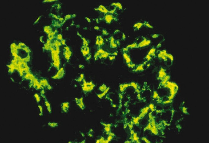 Immunofluorescence shows extensive deposits in the mesangium with deposits also seen focally in the subendothelial region and the capillary (400×)