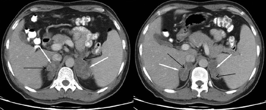 Contrast-enhanced axial CT section of the upper abdomen showing enlarged and hypodense bilateral adrenals (white arrows) with peripheral rim enhancement and enhancing internal septations (black arrows)