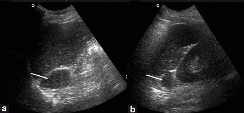 Ultrasonography of the abdomen revealing right (a) and left (b) adrenomegaly (arrows)