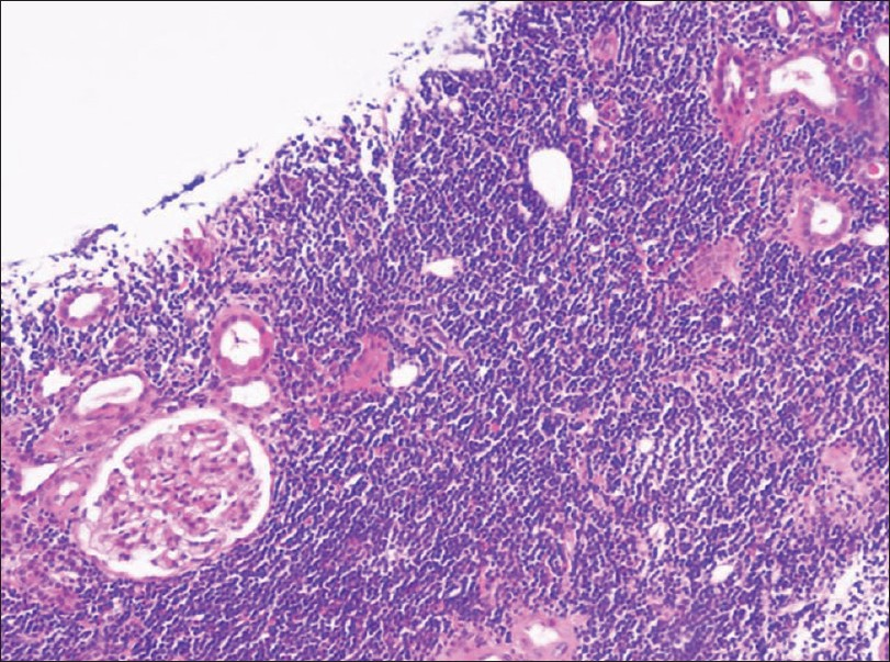 Renal biopsy demonstrating confluent B-CLL infiltration of the interstitum within which there are few glomeruli and tubules with preserved architecture (H and E; ×40 magnification)