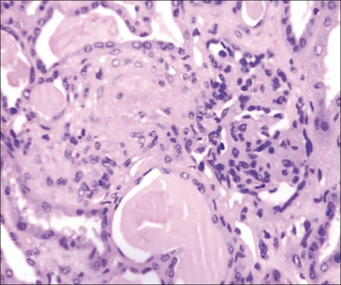 Histopathologic examination of the renal biopsy showing ischemic wrinkling of glomerular capillary basement membrane with endothelial cell swelling and obliteration of capillary lumina, and associated arteriole with fibrinoid necrosis of the wall and luminal obliteration (M, ×200)