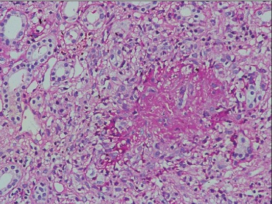 Renal biopsy showing interstitial granuloma with interstitial inflammation with loss of tubular architecture (H and E, 400×10)