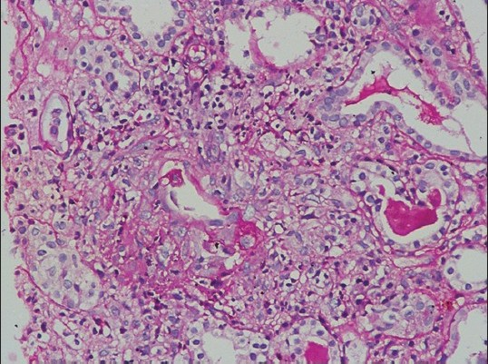Renal biopsy showing vascular inflammation and areas of necrosis (H and E, 400×10)