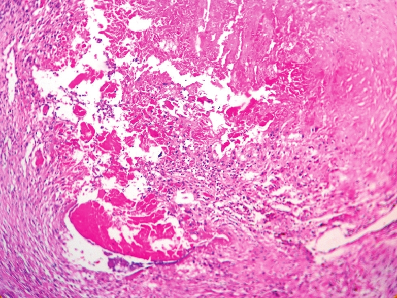 Histology of the valve with infective endocarditis. The figure shows a vegetation attached to the valve leaflet