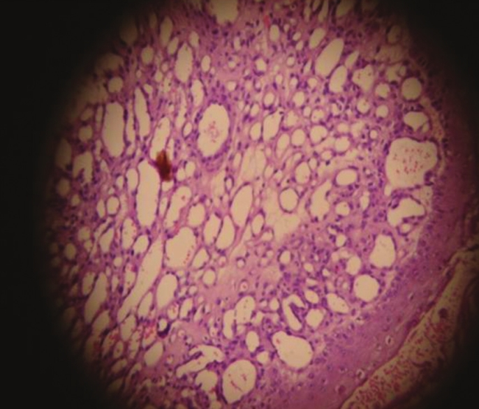 Photomicrograph showing proliferation of small- to medium-sized vessels lined by endothelial cell and spindle-shaped cells suggestive of Kaposi sarcoma