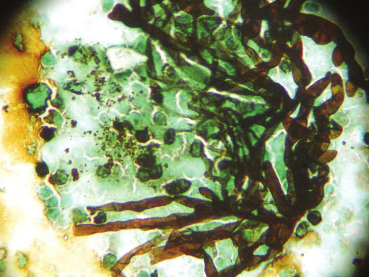 Methenamine silver stain showing mycelia (aseptate hyphae) and spores of Mucor