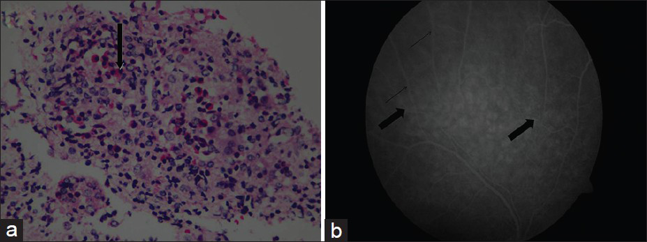 (a) Renal biopsy showing moderate to dense mixed inflammatory infiltrate composed of lymphocytes, plasma cells, neutrophils, and numerous eosinophils (arrow). H and E stain (×100) (b) Fluorescein angiography of right eye showing mild vitreous haze superiorly, leakage around the vessels superiorly (bold arrow), and fuzziness of the vasculature (thin arrow) in the superotemporal arcade, signifiying vasculitis of retina