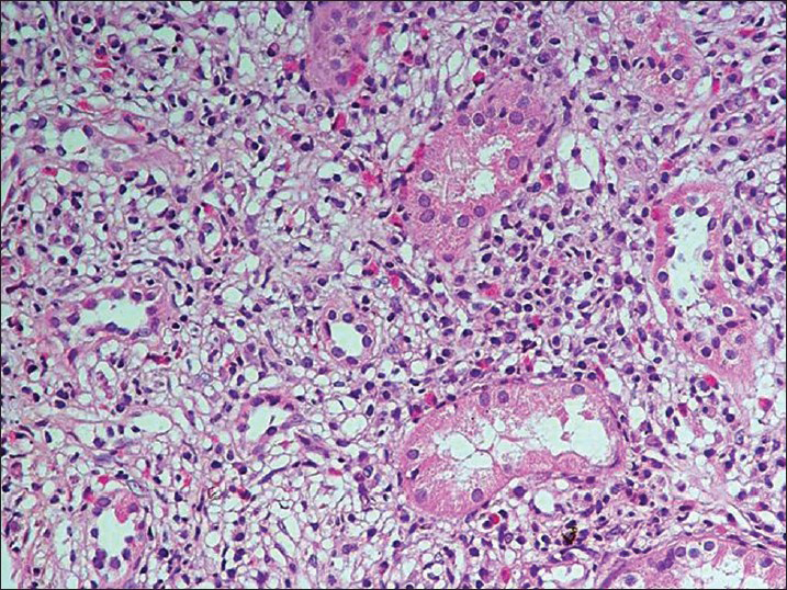 The tubules are separated out by fibrous connective tissue and an inflammatory infiltrate composed of lymphocytes