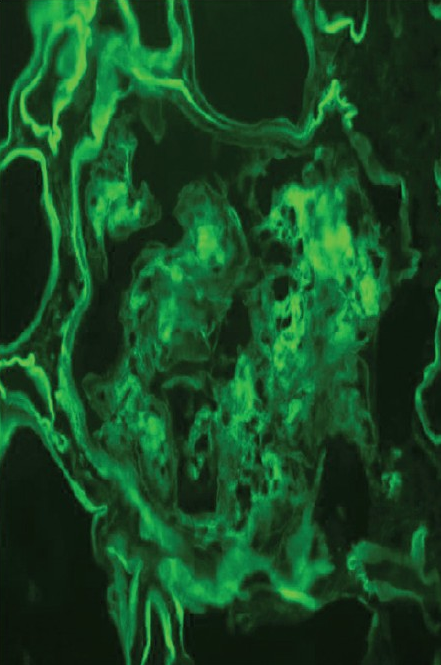 Immunofluorescence showing positivity with kappa-light chain in mesangium and tubular basement membrane