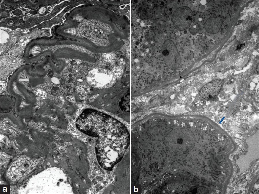 Electron microscopy showing powdery electron-dense material in lamina rara interna of glomerular basement membrane (a) and on the outer aspect of tubular basement membrane (b) (uranyl acetate, × 1080)